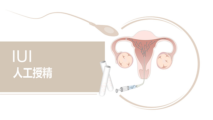 Sperm Preparation
