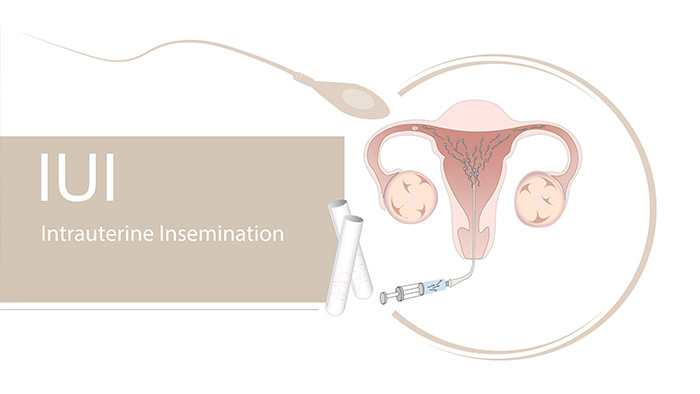 Sperm Preparation